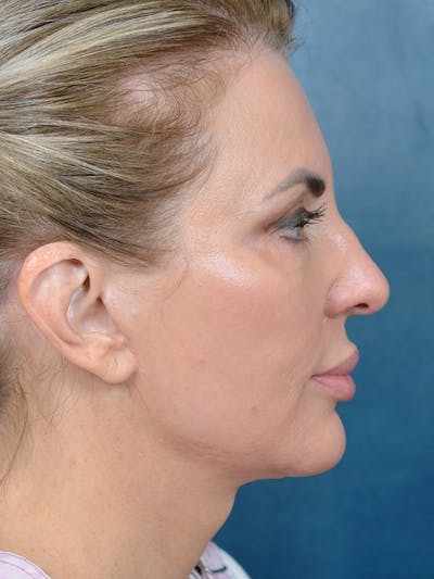 Deep Plane Facelift Before & After Gallery - Patient 123065419 - Image 8