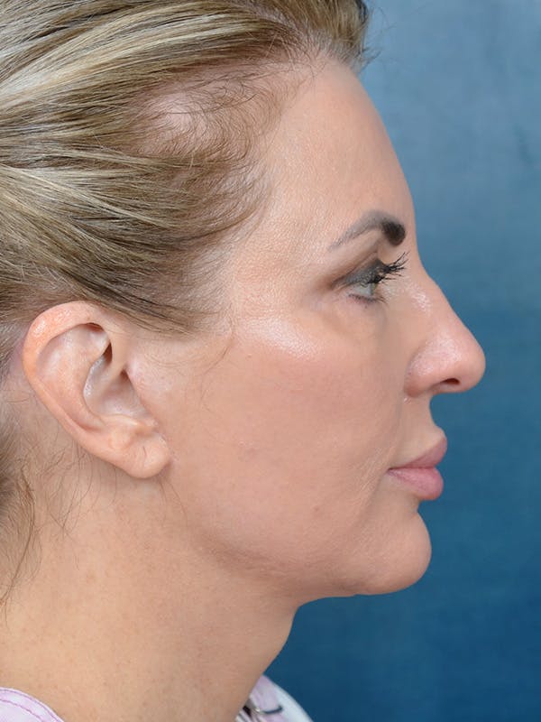 Deep Plane Facelift Before & After Gallery - Patient 123065419 - Image 8