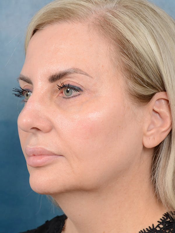 Deep Plane Facelift Before & After Gallery - Patient 123065419 - Image 1