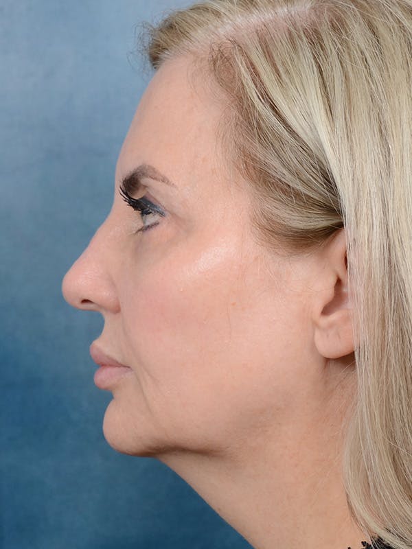Deep Plane Facelift Before & After Gallery - Patient 123065419 - Image 9