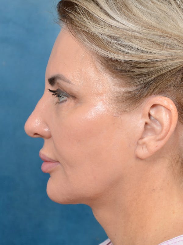 Laser Skin Resurfacing Before & After Gallery - Patient 123065423 - Image 10