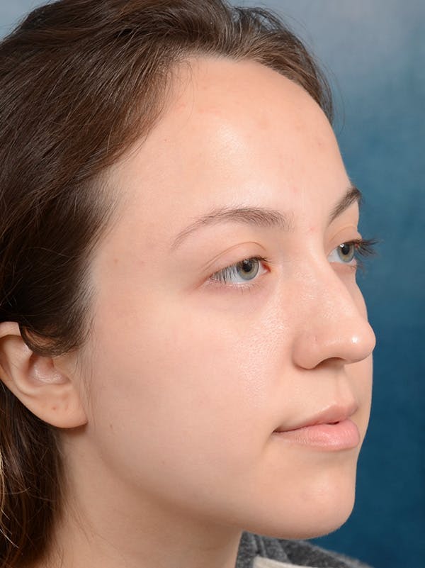 Rhinoplasty Before & After Gallery - Patient 123065433 - Image 5