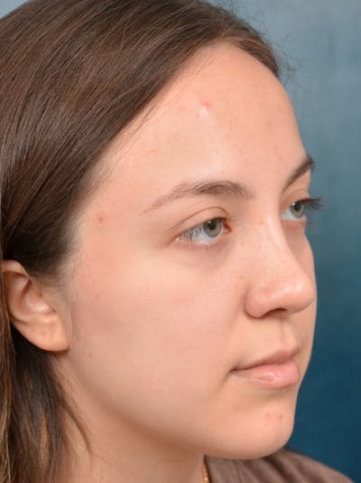Rhinoplasty Before & After Gallery - Patient 123065433 - Image 6