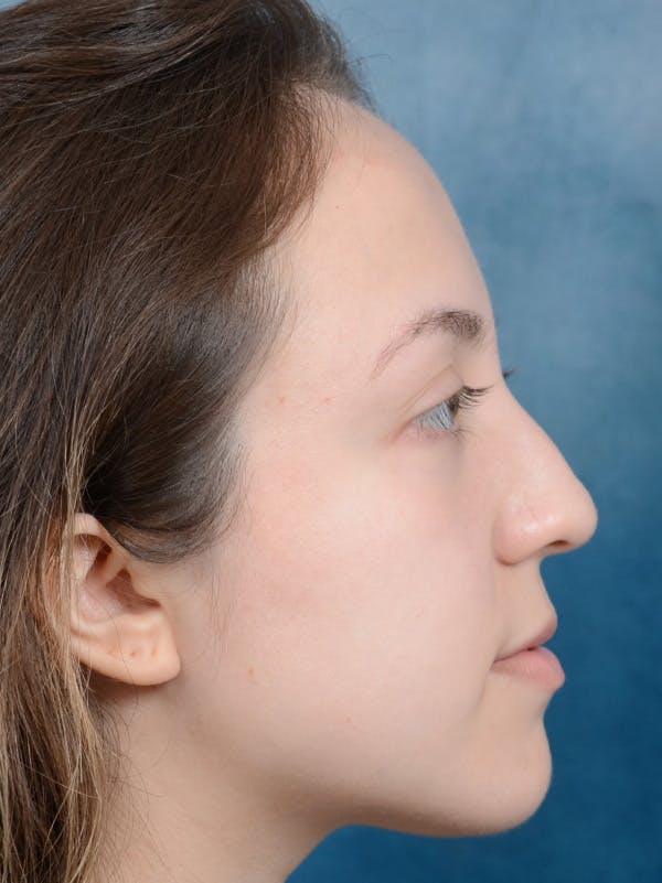 Rhinoplasty Before & After Gallery - Patient 123065433 - Image 7