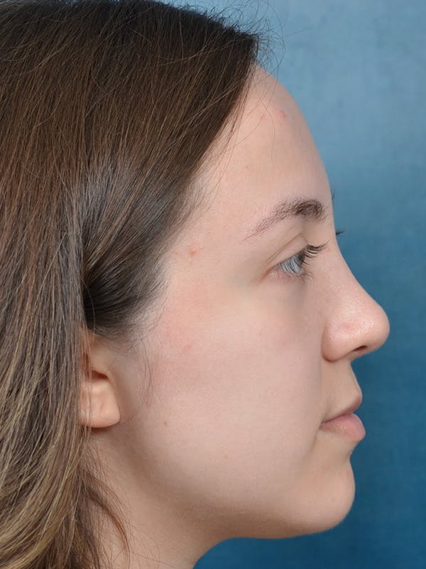Rhinoplasty Before & After Gallery - Patient 123065433 - Image 8