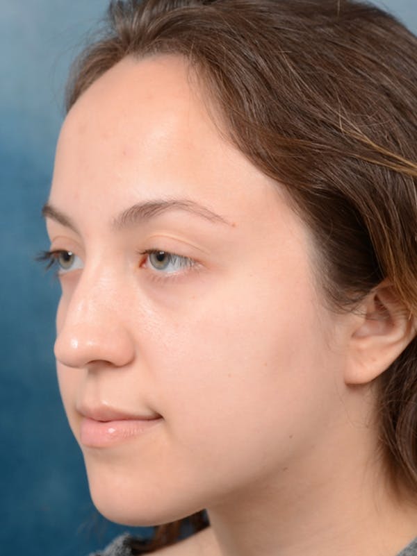 Rhinoplasty Before & After Gallery - Patient 123065433 - Image 9