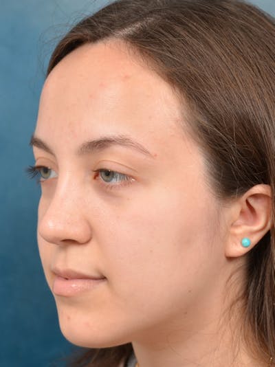 Rhinoplasty Before & After Gallery - Patient 123065433 - Image 10