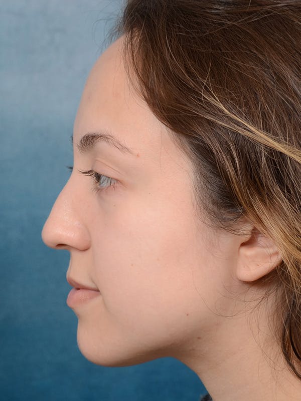 Rhinoplasty Before & After Gallery - Patient 123065433 - Image 1
