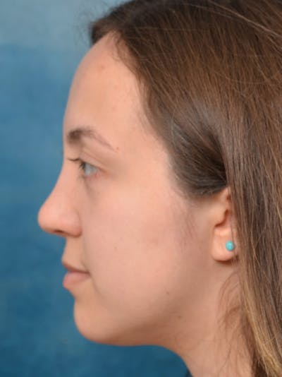 Rhinoplasty Before & After Gallery - Patient 123065433 - Image 2