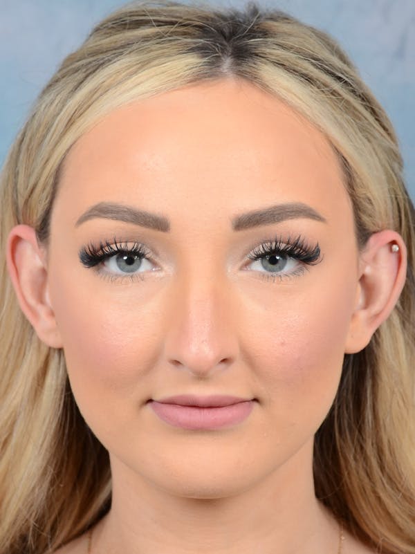 Rhinoplasty Before & After Gallery - Patient 123065436 - Image 3