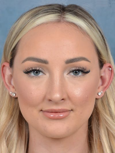 Rhinoplasty Before & After Gallery - Patient 123065436 - Image 4