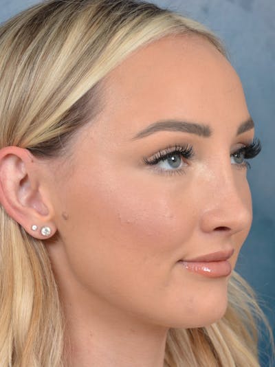 Rhinoplasty Before & After Gallery - Patient 123065436 - Image 6