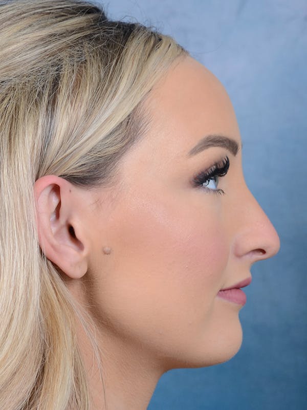 Rhinoplasty Before & After Gallery - Patient 123065436 - Image 7