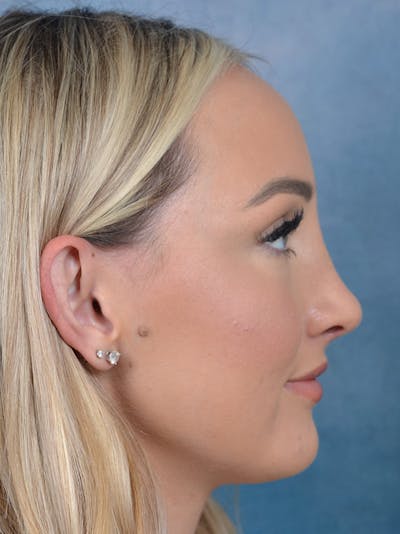 Rhinoplasty Before & After Gallery - Patient 123065436 - Image 8