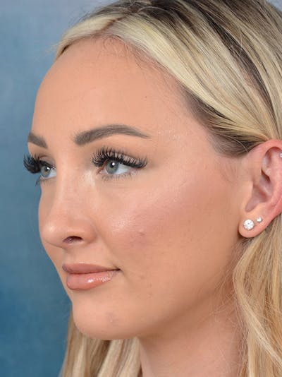 Rhinoplasty Before & After Gallery - Patient 123065436 - Image 10