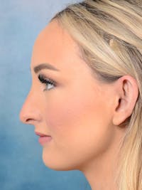 Rhinoplasty Before & After Gallery - Patient 123065436 - Image 1