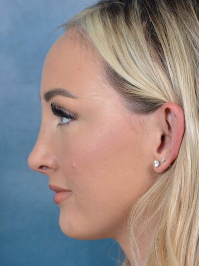 Rhinoplasty Before & After Gallery - Patient 123065436 - Image 2