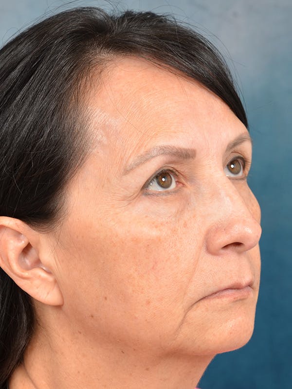 Chin Augmentation Before & After Gallery - Patient 123065439 - Image 3