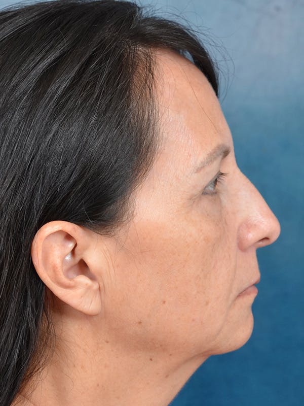 Laser Skin Resurfacing Before & After Gallery - Patient 123065444 - Image 5