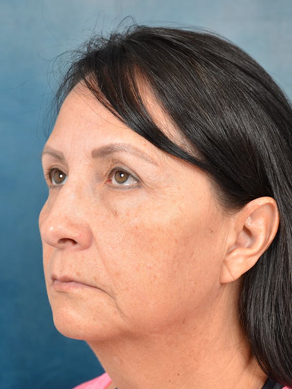 Chin Augmentation Before & After Gallery - Patient 123065439 - Image 7