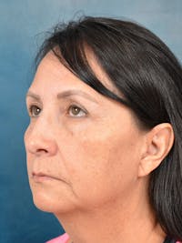 Deep Plane Facelift Before & After Gallery - Patient 123065438 - Image 1