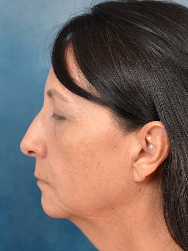 Brow Lift Before & After Gallery - Patient 123065446 - Image 9