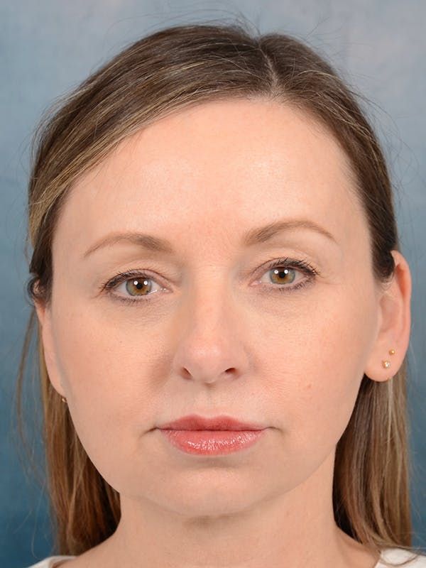 Rhinoplasty Before & After Gallery - Patient 123090406 - Image 3