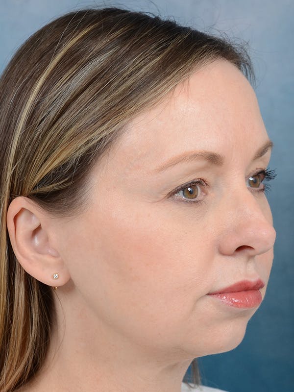 Rhinoplasty Before & After Gallery - Patient 123090406 - Image 5