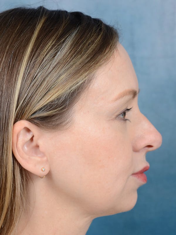 Rhinoplasty Before & After Gallery - Patient 123090406 - Image 7