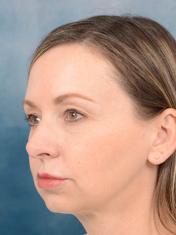 Chin Augmentation Before & After Gallery - Patient 123090412 - Image 7