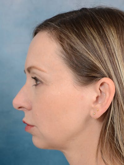 Rhinoplasty Before & After Gallery - Patient 123090406 - Image 1