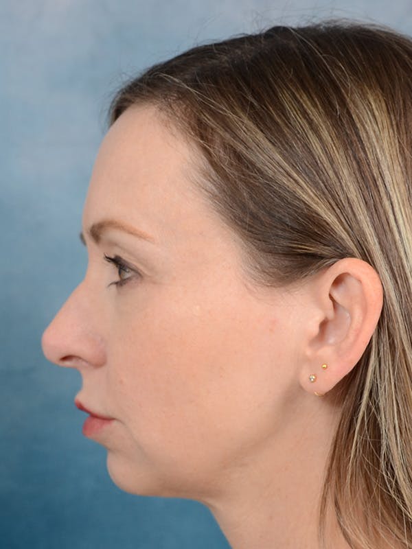 Chin Augmentation Before & After Gallery - Patient 123090412 - Image 9