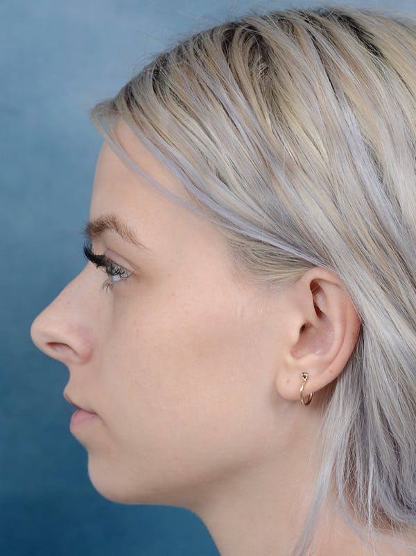 Rhinoplasty Gallery - Patient 123996967 - Image 1