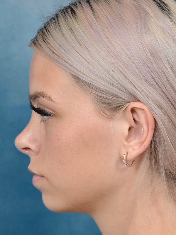 Rhinoplasty Gallery - Patient 123996967 - Image 2