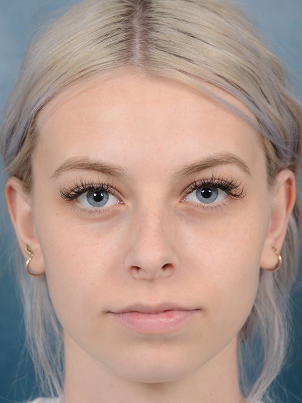 Rhinoplasty Gallery - Patient 123996967 - Image 3