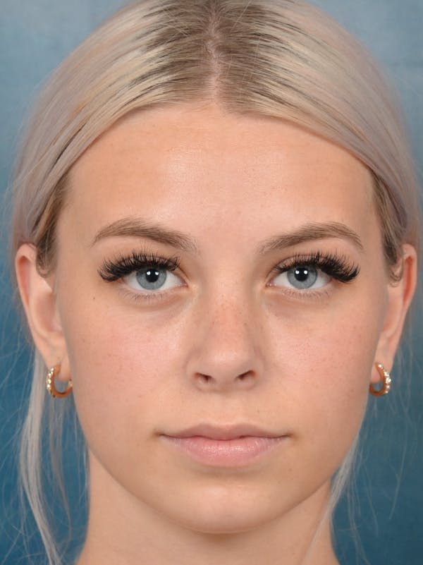 Rhinoplasty Gallery - Patient 123996967 - Image 4