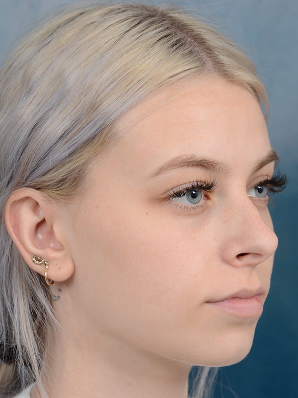 Rhinoplasty Gallery - Patient 123996967 - Image 5