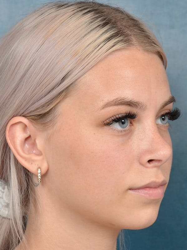 Rhinoplasty Gallery - Patient 123996967 - Image 6