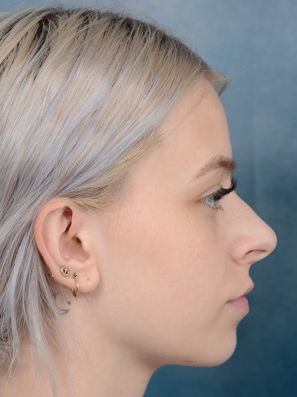 Rhinoplasty Gallery - Patient 123996967 - Image 7