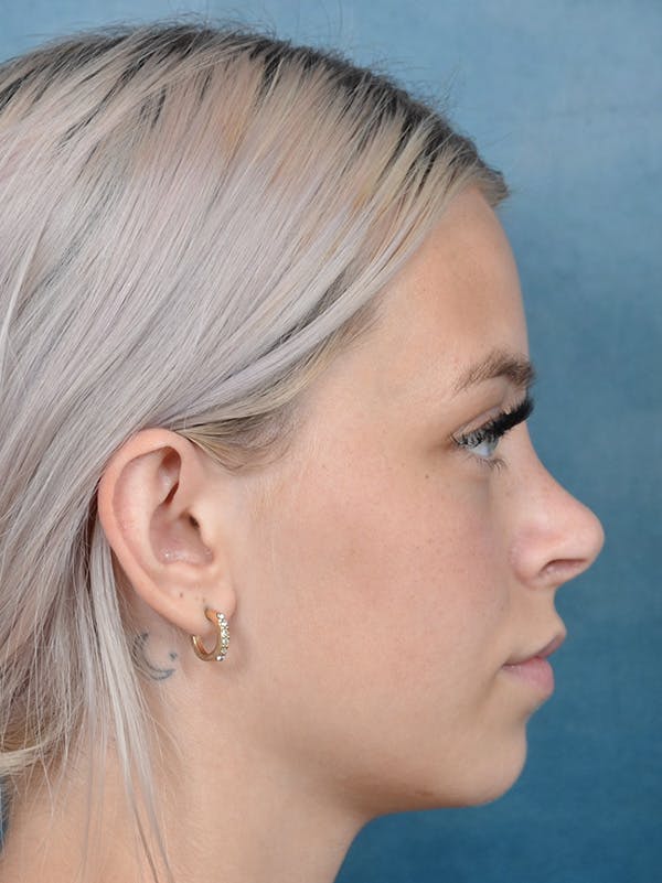 Rhinoplasty Gallery - Patient 123996967 - Image 8