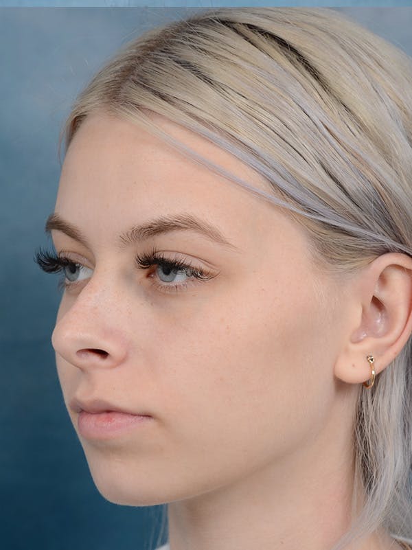 Rhinoplasty Gallery - Patient 123996967 - Image 9