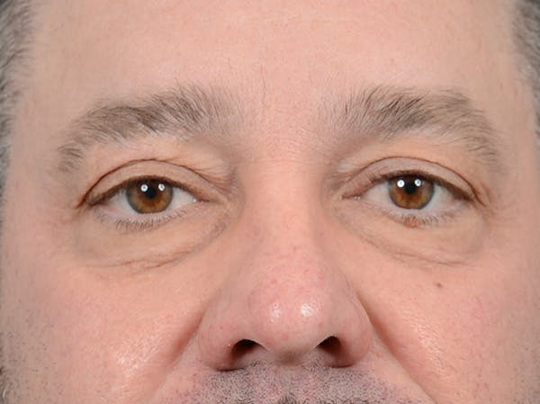Eyelid Lift Before & After Gallery - Patient 123718910 - Image 1