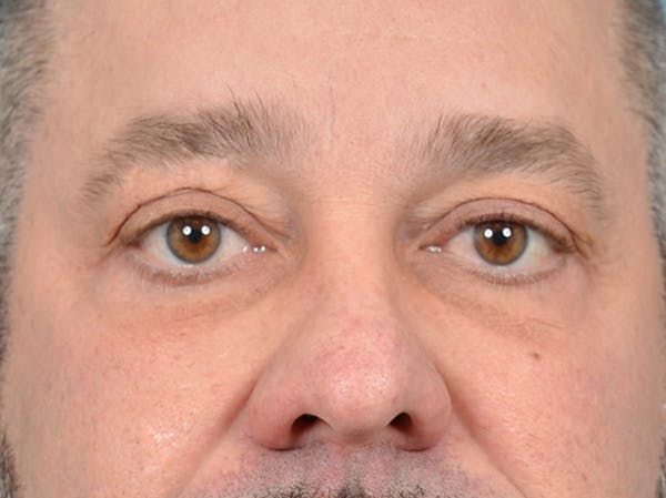 Eyelid Lift Before & After Gallery - Patient 123718910 - Image 2