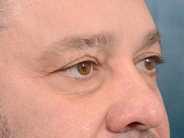Eyelid Lift Before & After Gallery - Patient 123718910 - Image 3