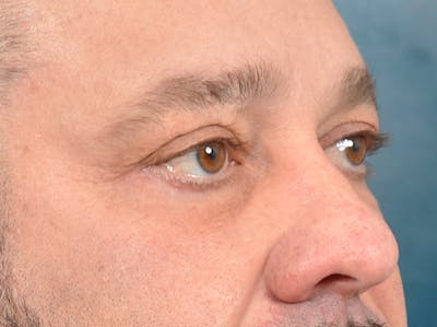Eyelid Lift Before & After Gallery - Patient 123718910 - Image 4