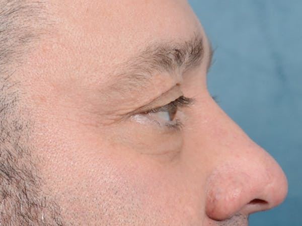 Eyelid Lift Before & After Gallery - Patient 123718910 - Image 5