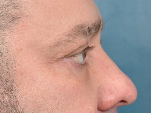 Eyelid Lift Before & After Gallery - Patient 123718910 - Image 6