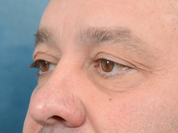 Eyelid Lift Gallery - Patient 123718910 - Image 7