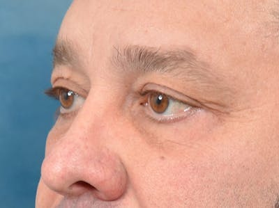 Eyelid Lift Before & After Gallery - Patient 123718910 - Image 8