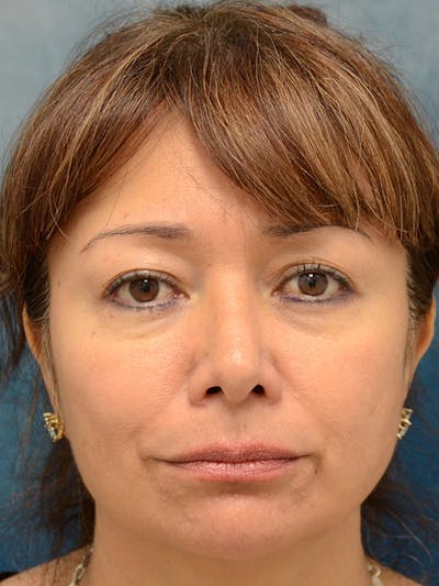 Eyelid Lift Before & After Gallery - Patient 123718986 - Image 1